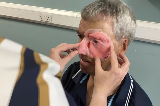 Пострадавшему в аварии мужчине напечатали часть лица на 3D-принтере